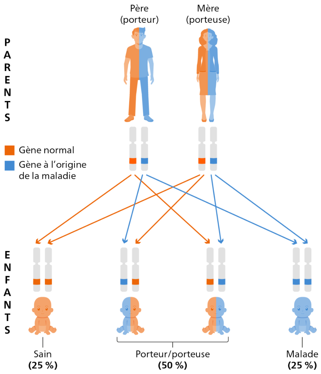 Message clé de l’infographie : les « porteurs » ne portent qu’une copie d’un gène responsable d’une maladie et sont eux-mêmes en bonne santé. Lorsque deux porteurs ont des enfants ensemble, il y a 25 % de chances que l’enfant hérite de deux copies du gène responsable de la maladie et que la maladie se déclare. Dans 50 % des cas, l’enfant n’hérite que d’une copie du gène responsable de la maladie et est lui-même considéré comme porteur ou porteuse. Dans les 25 % restants, l’enfant hérite de deux copies normales du gène et est considéré comme sain.